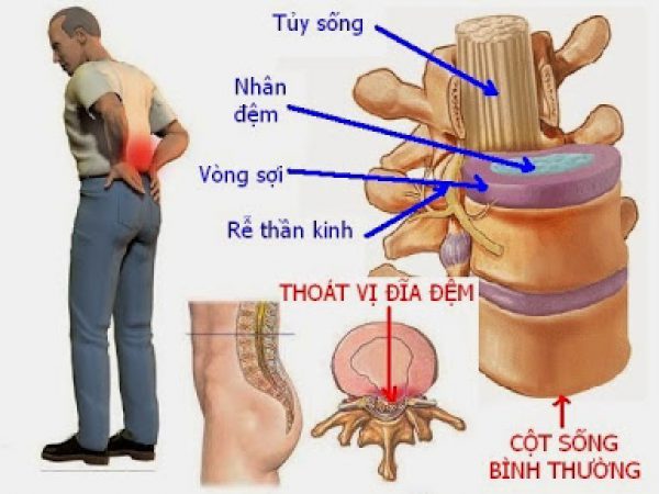 Thoát vị kẽ - Hình ảnh minh họa